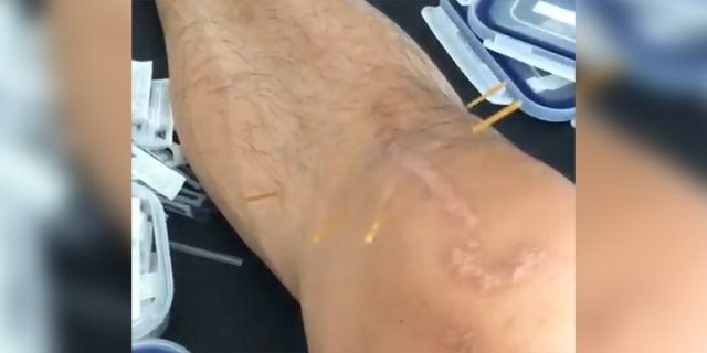林书豪晒接受针灸视频 膝盖伤疤触目惊心