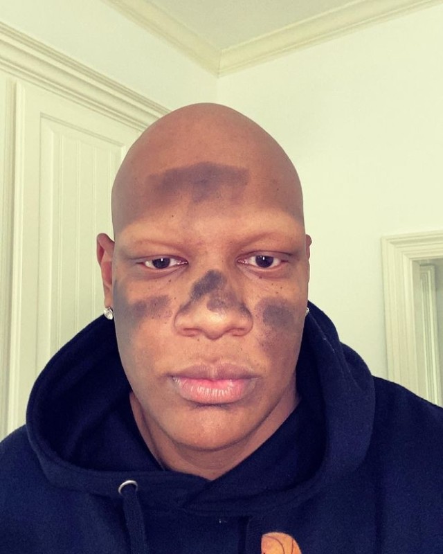 快讯>正文事后,维拉纽瓦也发了一张自己的脸被烧得黢黑的照片,他还开