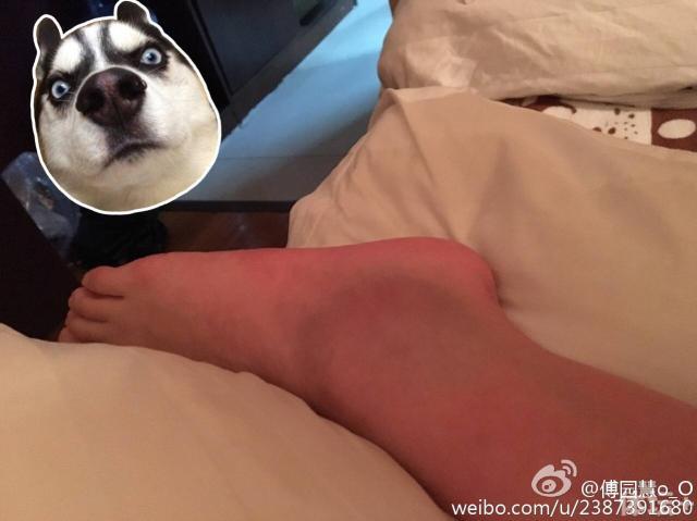 洪荒少女傅园慧不玩表情包晒伤脚惹人疼